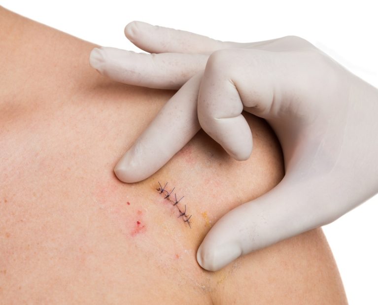 cirurgia-de-cancer-de-pele